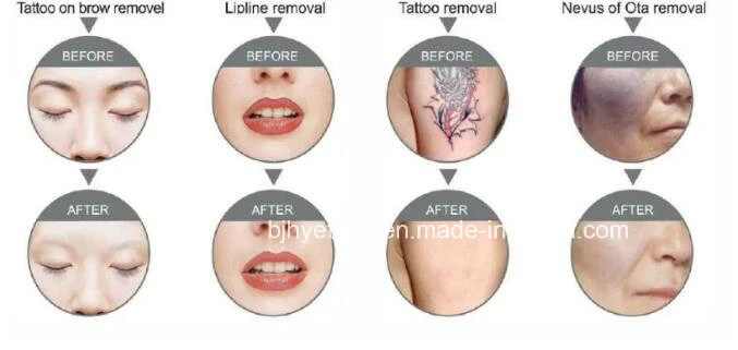 Q Switch Laser Tattoo Removal/1064/532/1320nm ND YAG Laser Carbon Peeling